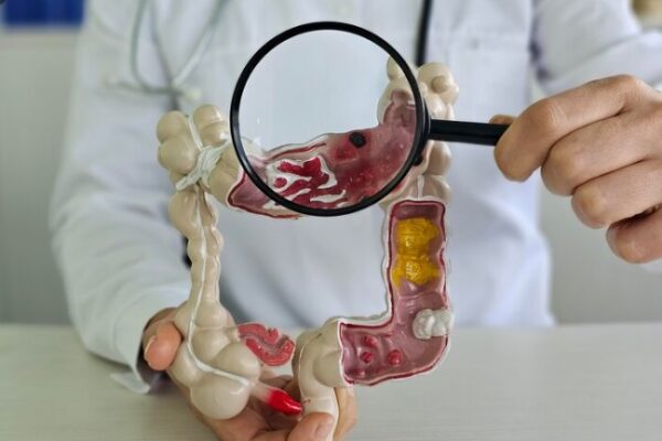 FOTO Pesquisa del cancer colorrectal y anal todo lo que debes saber